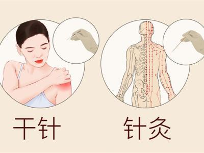 什么是針灸療法